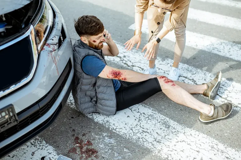 Injured pedestrian with visible scrapes and road rash sitting on a crosswalk after being hit by a car, making an emergency call while a witness assists, ideal for pedestrian accident law and injury claim content.